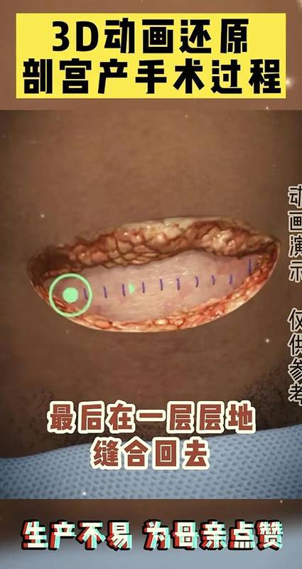  「生命故事·情感共鸣」：当妈后才懂——剖腹产那一刀，究竟划开了什么？ 情感心理