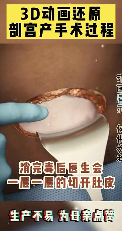  「生命故事·情感共鸣」：当妈后才懂——剖腹产那一刀，究竟划开了什么？ 情感心理