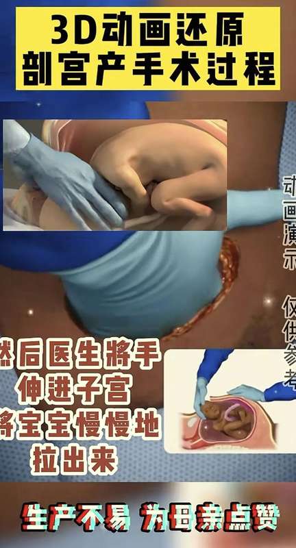  「生命故事·情感共鸣」：当妈后才懂——剖腹产那一刀，究竟划开了什么？ 情感心理